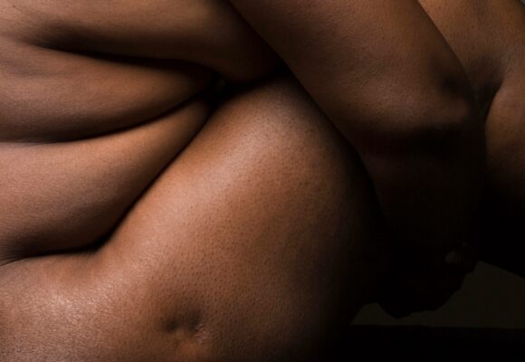 VzQ7i975Rqs-POST Obesity, the Pelvic Floor and Surgery Risk